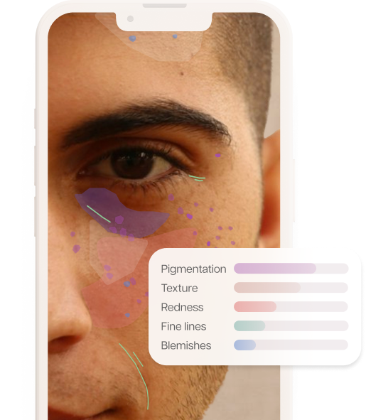 Mobile phone showing results of AI facial skin analysis on a man's face